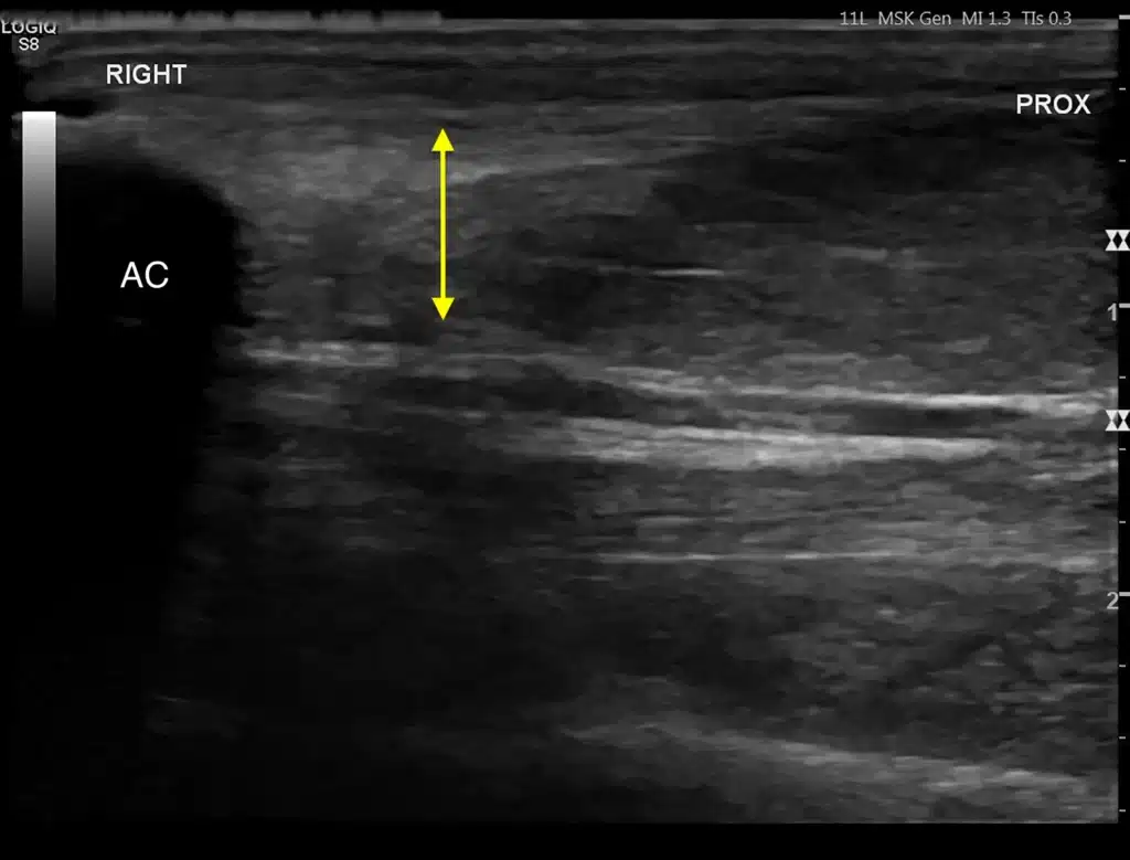 Tendon injury in dogs 7 Figure 3B